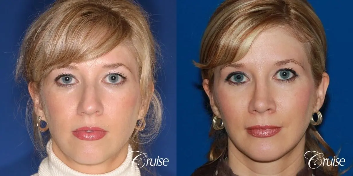 female patient with best chin implant scar - Before and After 1