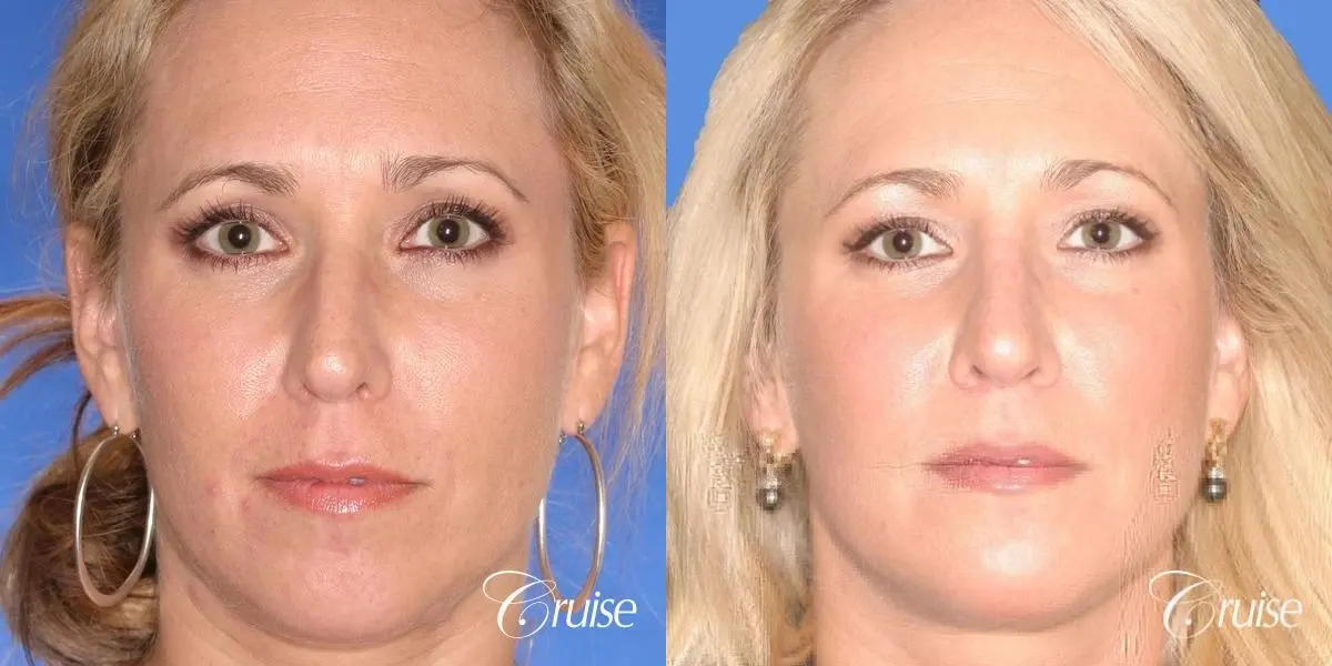 female with natural looking chin implant - Before and After 1