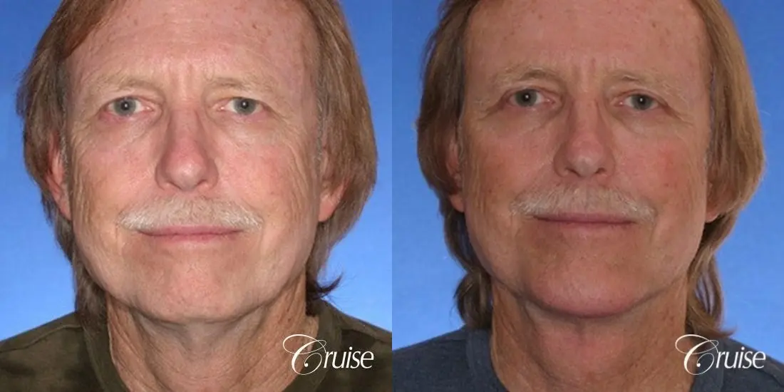 62 yr old with medium square chin augmentation - Before and After 1