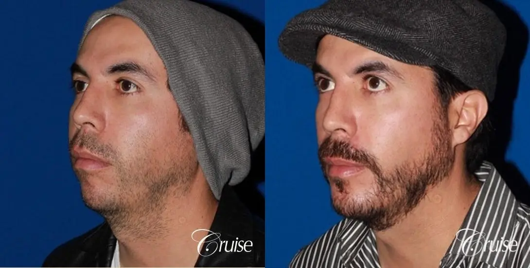 male patient with large chin augmentation - Before and After 3