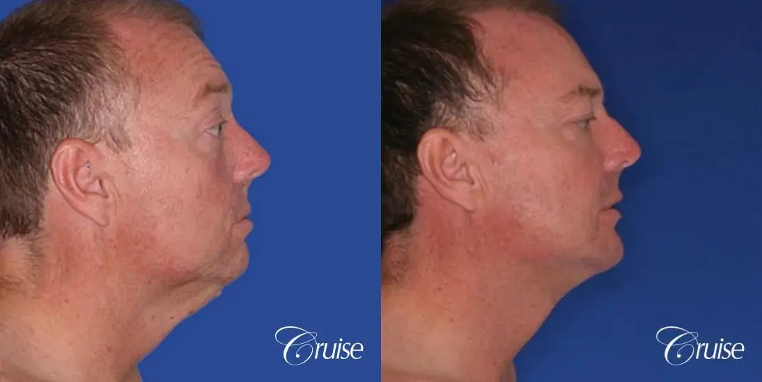 best male chin implant with large square jaw - Before and After 2