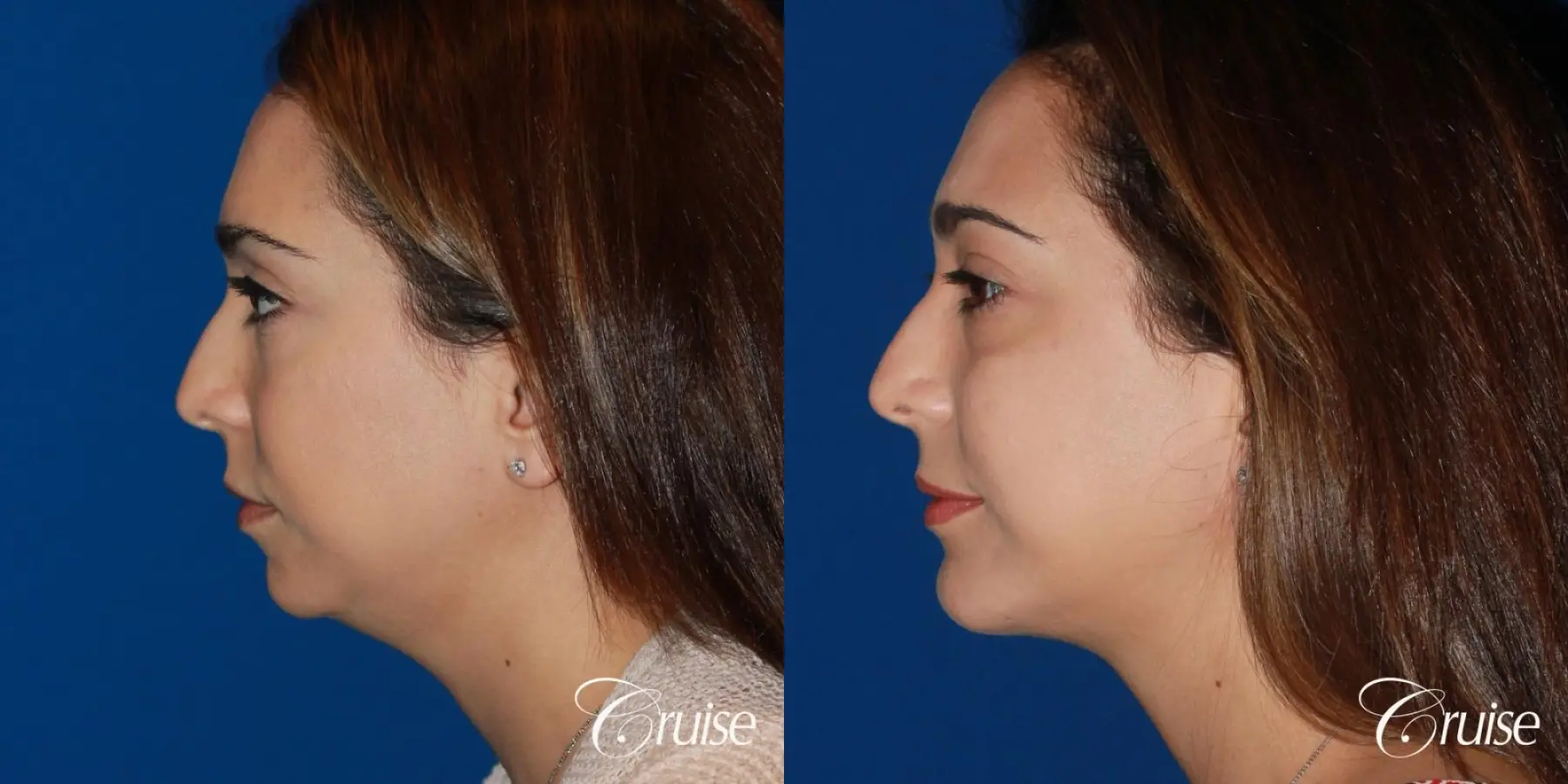 best medium chin implant on young patient - Before and After 2