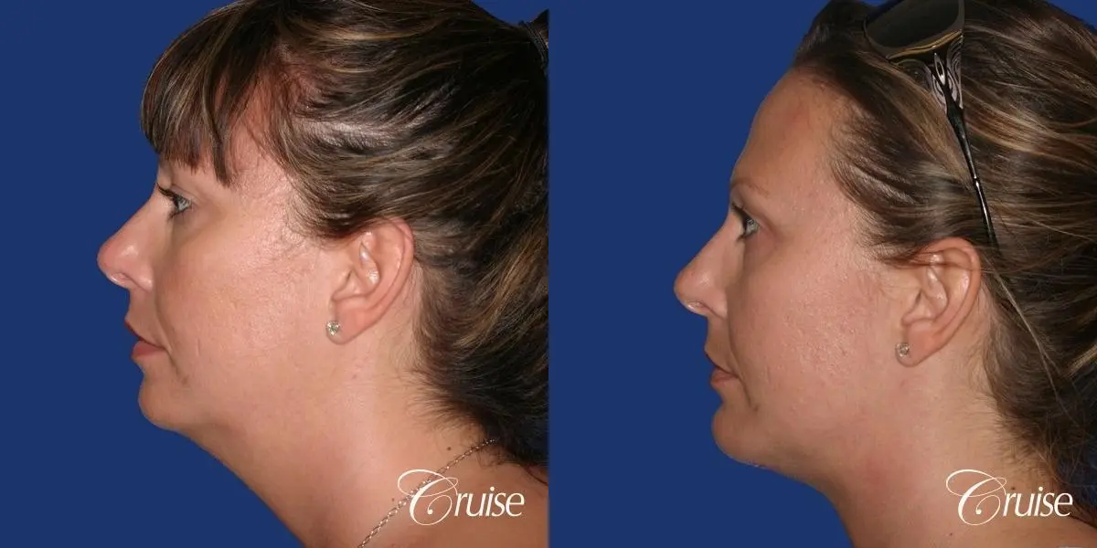 best before and after of chin augmentation medium implant - Before and After 2