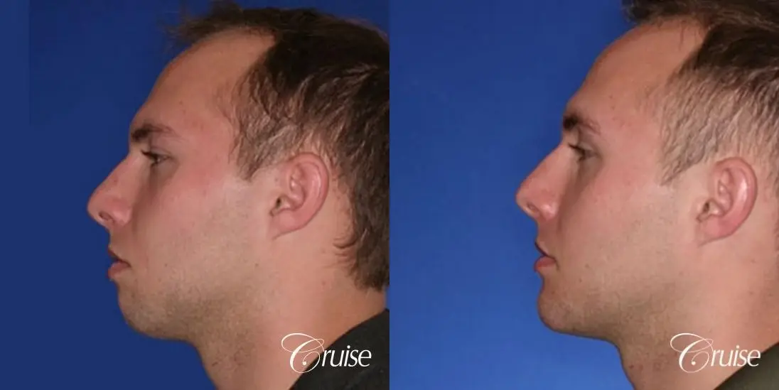 best chin implant on male with medium square jaw - Before and After 2