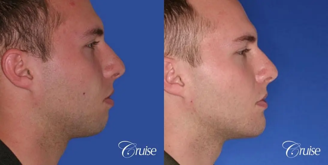 best chin implant on male with medium square jaw - Before and After 3