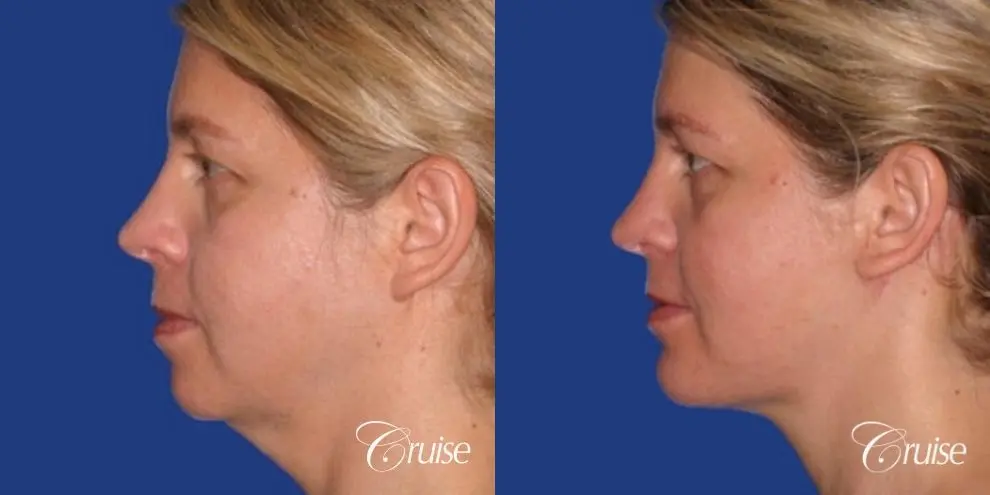 female who got large chin implant in Newport Beach - Before and After 2