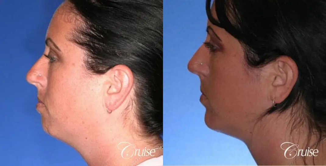 before and after photos of female chin implant - Before and After 2