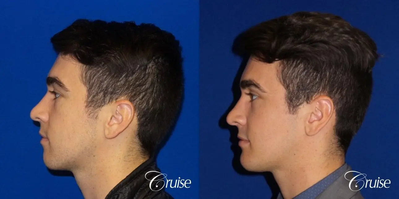 Best chin augmentation pictures for men - Before and After 3