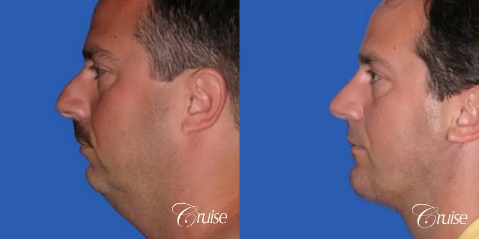 terino square jaw implant after best chin augmentation - Before and After 2