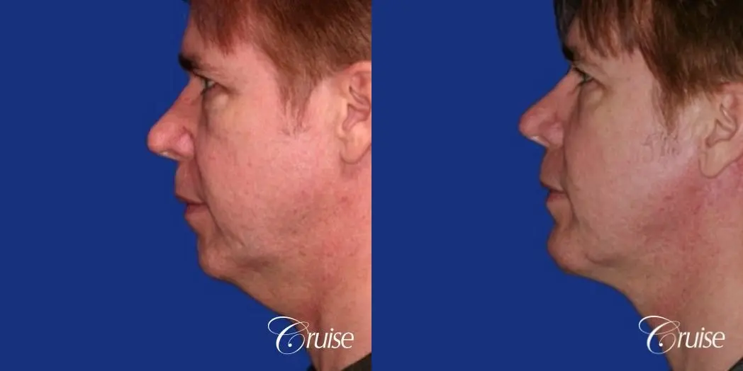 male with best scar for chin implant - Before and After 2