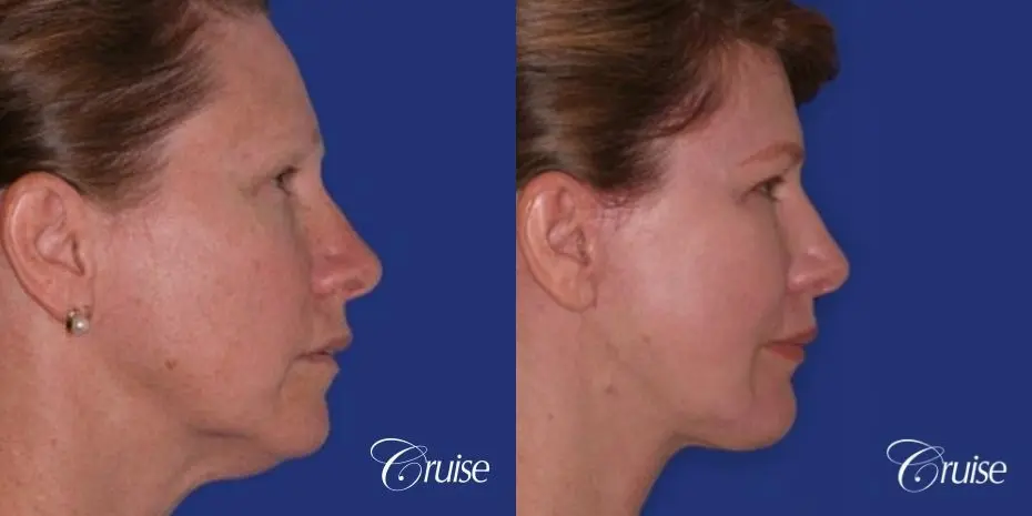 52 year old with chin augmentation and facelift - Before and After 3