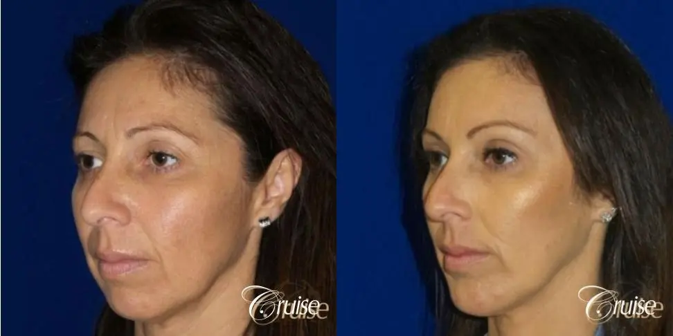Chin Augmentation -Extra Large Anatomic Implant - Before and After 2