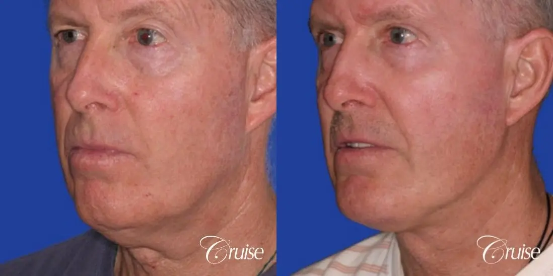 62 year old with chin implant and neck lift - Before and After 2