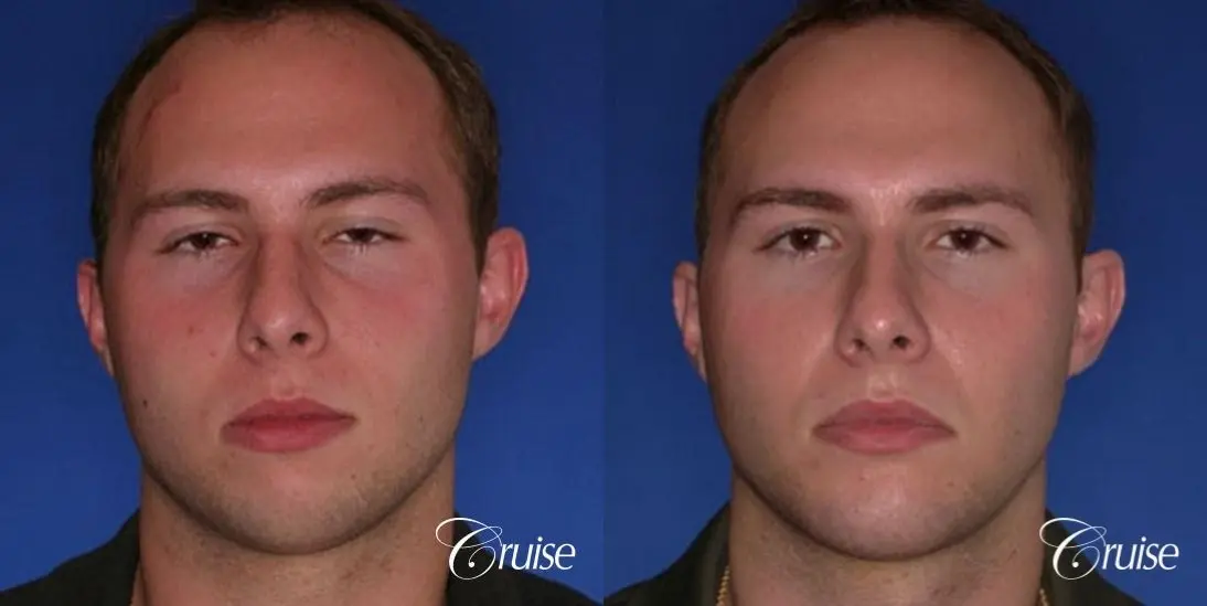 best chin implant on male with medium square jaw - Before and After 1