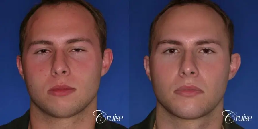 best chin implant on male with medium square jaw - Before and After
