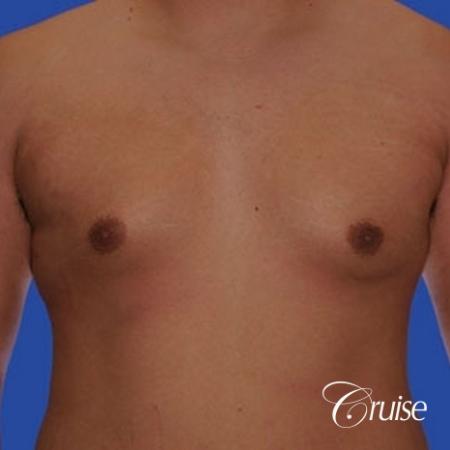 mild gyne on 24yr old adult - Before Image 1
