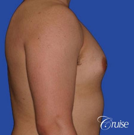 minor gyne young adult with best scars - Before Image 3