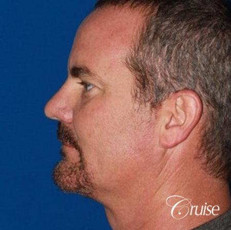 best pictures of chin augmentation with specialist - After Image 2
