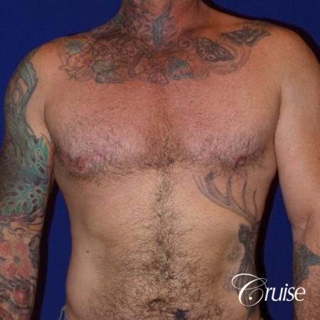 Moderate Gynecomastia -Areola Incision - After Image 1