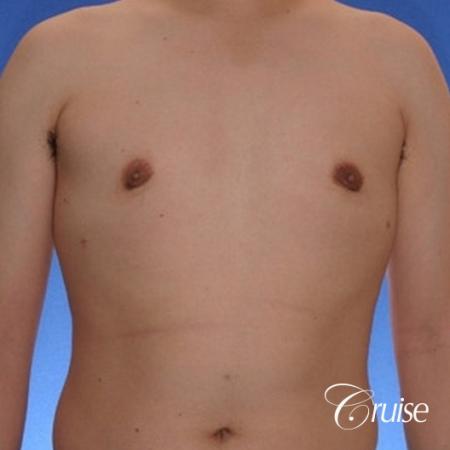 young male with mild gynecomastia surgery for puffy nipple - After Image 1