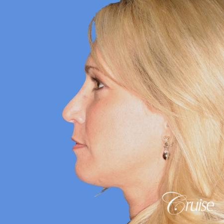 female with natural looking chin implant - After Image 2