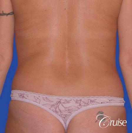 liposuction abdomen flanks with tummy tuck - Before Image 1