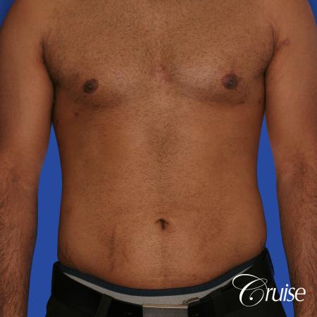 young adult with gyno gets gynecomastia surgery - After Image 1