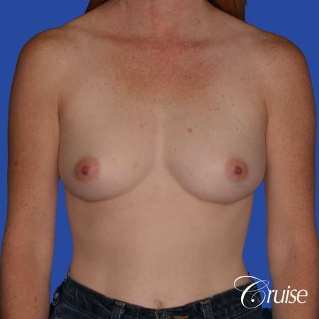 Breast Augmentation - Before 1