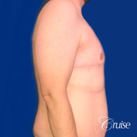 Pedicle incision Dr. Cruise Newport Beach CA - After Image 4