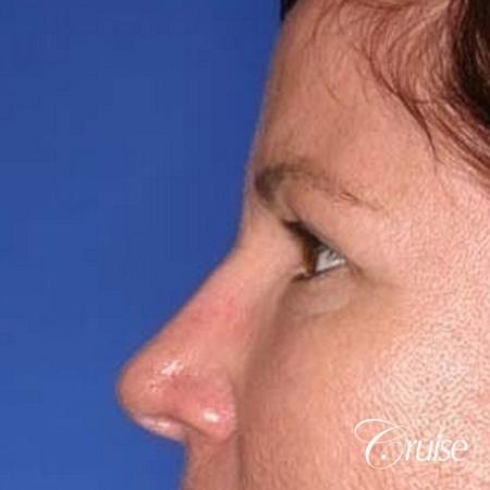 best plastic surgery on upper eyelids - Before Image 2