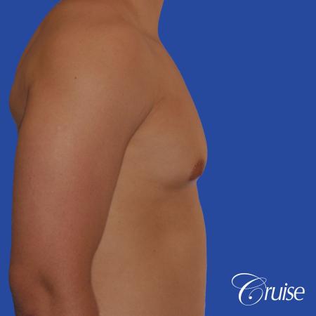 mild gynecomastia with puffy nipple and areola incision - Before and After Image 3