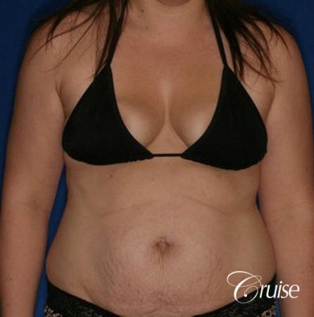 best results on young woman for breast lift anchor with saline augmentation - Before and After Image 5
