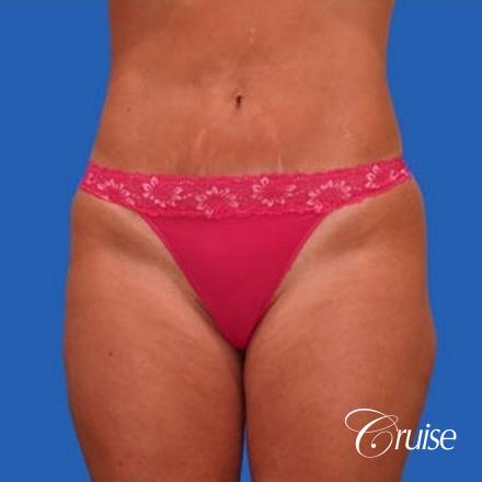 before and after pictures of liposuction abdomen and flanks - After Image