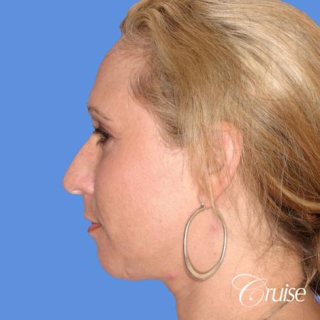 female with natural looking chin implant - Before and After Image 2
