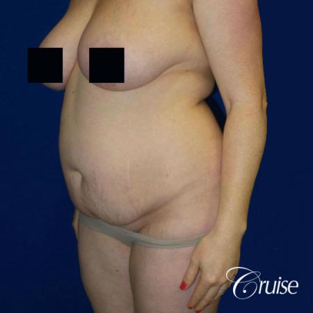 Best tummy tucks dr cruise - Before Image 3