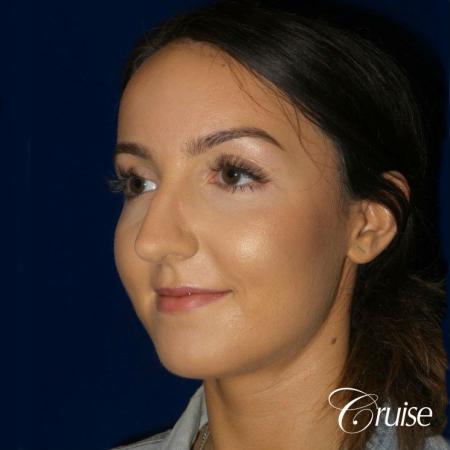 Rhinoplasty Dr. Cruise newport beach - Before Image 4