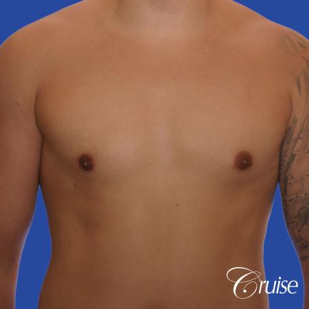 mild gynecomastia with puffy nipple and areola incision - After Image 1