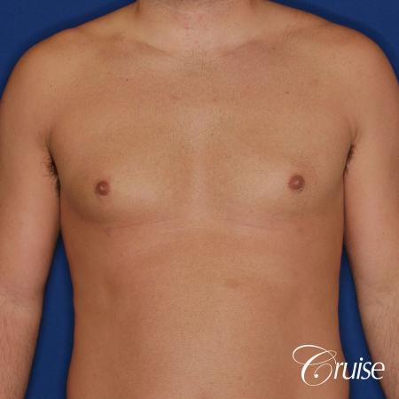 male patient has mild gynecomastia - After Image 1