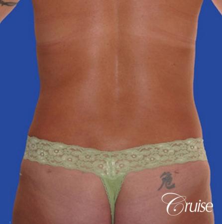 liposuction abdomen flanks with tummy tuck - After Image 1