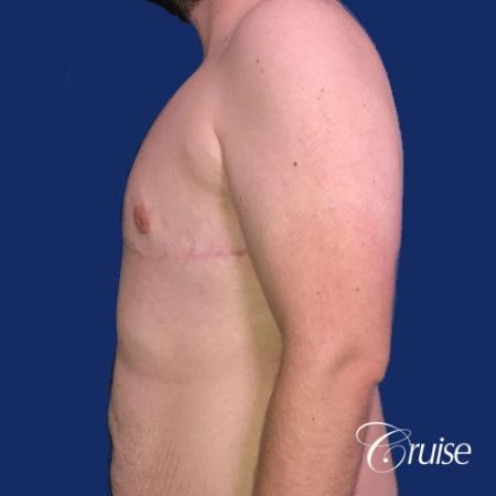 Pedicle incision Dr. Cruise Newport Beach CA - After Image 2