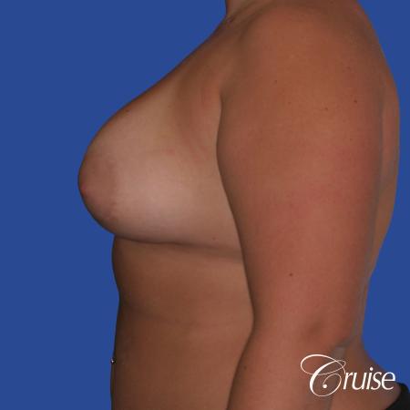 Breast Augmentation - After Image 2