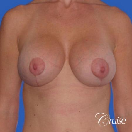 best breast lift anchor with silicone implants - After Image 1