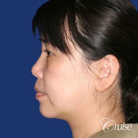 best chin implant photos with large implant - After Image 2