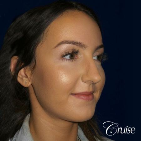Rhinoplasty Dr. Cruise newport beach - Before Image 2