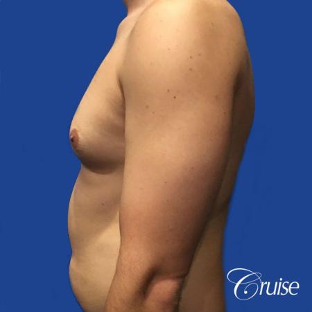 gyne before and after photos orange county ca - Before and After Image 3