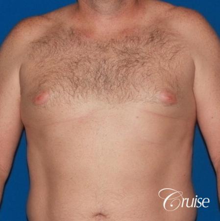 mild puffy nipple on 42 year old - Before Image 1