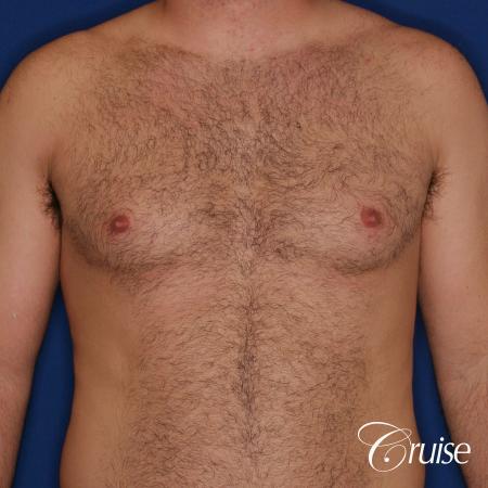 male patient has mild gynecomastia - Before Image 1
