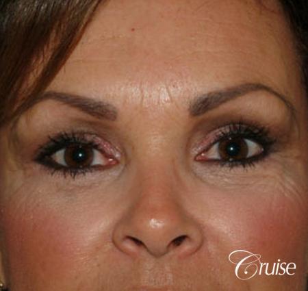 best blepharoplasty eye surgery photos - After Image 1