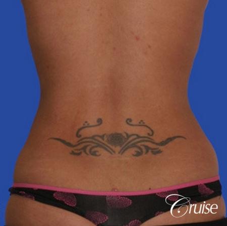 top plastic surgeon for liposuction in Newport Beach - After Image 3