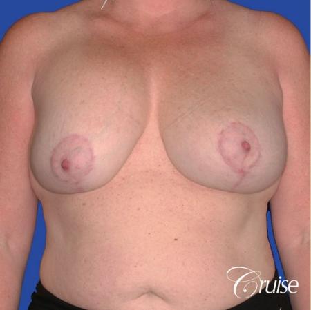 capsular contracture before and after pictures in Newport Beach - Before 1